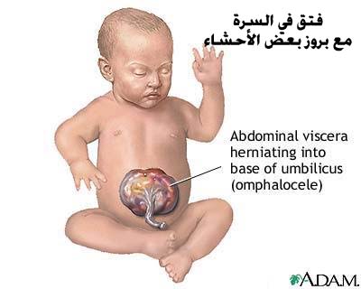 Beckwith-Wiedemann syndrome Beckwith-Wiedemann_syndrome (5).jpg